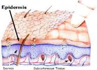 What is    Microdermabrasion?